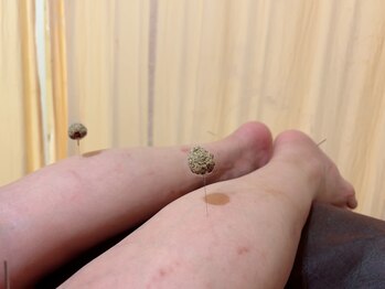 鍼灸ハウス(鍼灸house)/