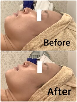 スペチアーレ 夙川/リフトアップ効果抜群