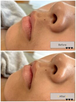 ブリス(BLISS.)/産毛と古い角質も除去！