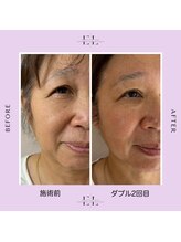 メルティ(Melty)/【細胞にアプローチ】ExoLift