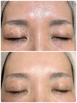 エソア(esoa)/目元に特化したシミケア