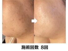 ハーブピーリング&毛穴洗浄専門店 肌REVO 高田馬場店[ニキビ/毛穴/たるみ/美白/シミ]/ハーブピーリング/ニキビケア