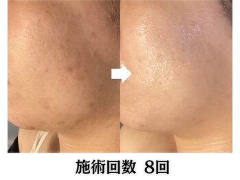 ハーブピーリング&毛穴洗浄専門店 肌REVO 高田馬場店[ニキビ/毛穴/たるみ/美白/シミ]/ハーブピーリング/ニキビケア