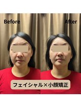 フェイエール鍼灸院 ラスィーヌ(fier鍼灸院 racine)/フェイシャル×小顔矯正