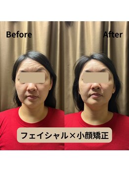 フェイエール鍼灸院 ラスィーヌ(fier鍼灸院 racine)/フェイシャル×小顔矯正