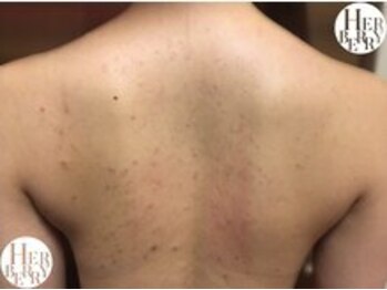 ハーバリー ハーブピーリング 難波心斎橋店(HERBERRYハーブピーリング)/なんばハーブピーリングHERBERRY