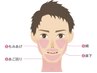 メンズヒゲ光脱毛