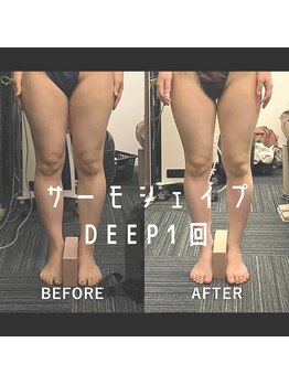 リラクゼーションサロン ラキ(laki)/サーモシェイプDEEP/痩身