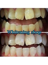 ホワイトニングショップ 本八幡店/Before&After美白ホワイトニング