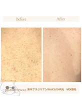 グルーミー(gloomy)/背中の脱毛！夏場大人気！