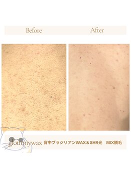 グルーミー(gloomy)/背中の脱毛！夏場大人気！