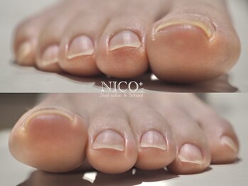 ニコプラス(NICO+)の写真/足の爪周りのカチカチな皮膚/汚れや甘皮/皮膚に食い込んだ爪等トラブルに応じたプロによる丁寧なネイルケア