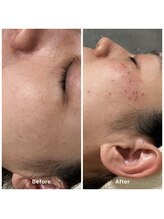 ゆりの花/シミケア