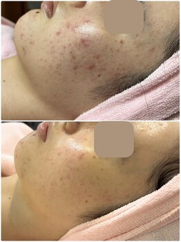 エステティックサロン アールグレー/肌質改善/ニキビ