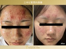 トゥジュール イエリック(Toujours ierik)/ニキビ肌荒れケア