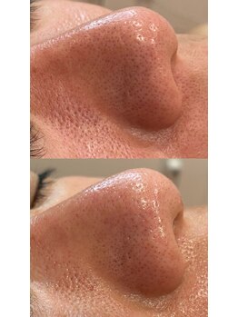 ディオーネ 春日井勝川店(Dione)/毛穴洗浄☆ビフォーアフター