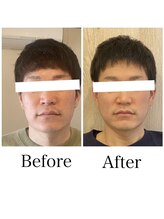 サロンベイビー 尼崎塚口店(Salon Baby)/【小顔美容整顔】Before・After