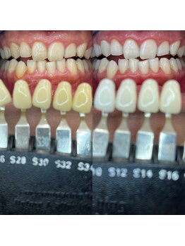 トウキョウスワーズ 池袋店(TOKYO SWRS)/#ホワイトニング #池袋 #渋谷