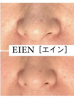 ザ エステティック福岡/肌荒れの原因の皮脂汚れ・黒ずみ