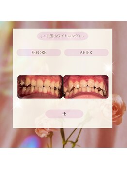 プラスビーセルフ(+b self)/ホワイトニングビフォーアフター