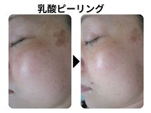 ラディアント たまプラーザ/乳酸ピーリング(スノーピール)