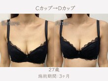 ハリスタ 梅田院(HARISTA)/3ヶ月間でCカップ→Dカップ