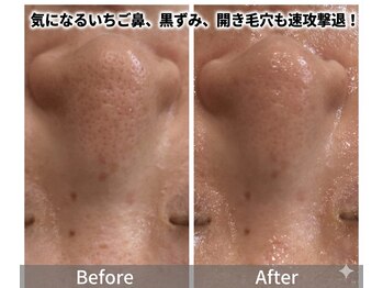 イノエ(inoe)の写真/【最新マシン導入!医療提携salon★毛穴/ニキビケア】剥離無し,毛穴悩み徹底除去!結果重視の毛穴レス肌へ
