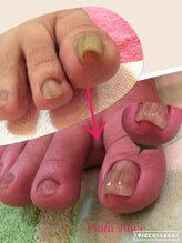 ネイルセラピーサロン プラムジュース(Nail Therapy Salon Plum Juice)/食い込み爪