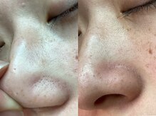 イトコ(ITOCO)/毛穴洗浄ビフォーアフター