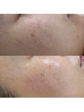 ハーナウ ハウ(hanau hou)/ハーブピーリング効果