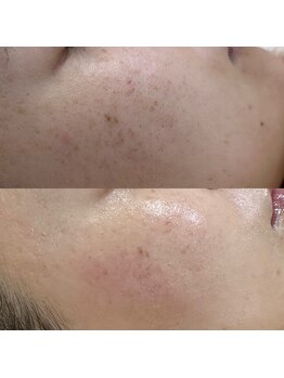 ハーナウ ハウ(hanau hou)/ハーブピーリング効果