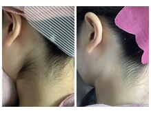 ルル(RuRu)/ Wax脱毛