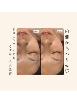 ディサイドロー(DECIDE L.A.W)/眉間も1回で変わる！