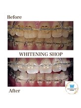 ホワイトニングショップ 小山店/【ビフォーアフター】