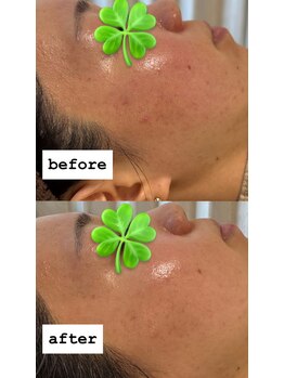 ヒーリングハーツ(Healing Hearts)/ハーブピーリング/肌質改善!