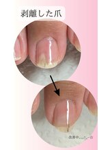 リラマジック (Rela-Magic)/剥離