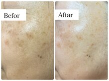 リラビューティー(Lilas Beauty)/プラチナムディープインジェット