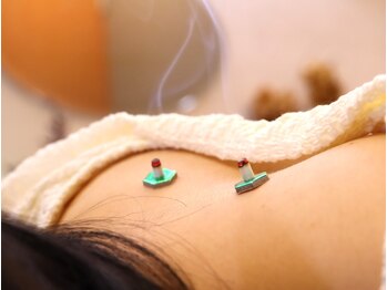 なみつき鍼灸整骨院/鍼灸施術