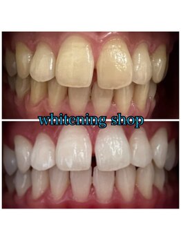 ホワイトニングショップ 高知店/ホワイトニング比較写真♪
