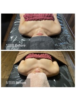 リノレア(LinoLea)/バストアップBefore after