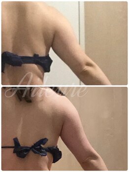 エルール トータルビューティ(Aileure total beauty)/インディバ二の腕