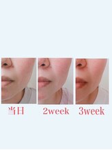 ブロッサム 山内店/フェイスリリース効果☆3week後