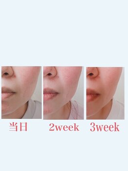 ブロッサム 山内店/フェイスリリース効果☆3week後