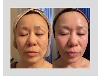 ルシーマ/エンダモリフトフェイシャル5回