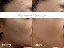 ワールドビューティー(World Beauty)/ADS肌改善結果(1年)