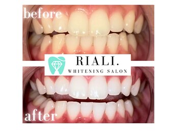 リアリ 宮崎(RIALI.)/プラチナホワイトニング