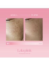 フレイヤビューティー スハダラボ 恵比寿(Freyia Beauty Suhada LABO)/-ララピンク-