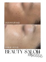 ソレラ(sorelle)/シミケア