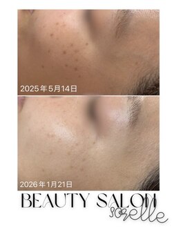 ソレラ(sorelle)/シミケア