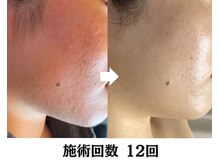 ハーブピーリング&毛穴洗浄専門店 肌REVO 高田馬場店[ニキビ/毛穴/たるみ/美白/シミ]/ハーブピーリング/ニキビケア